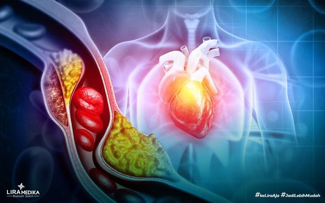 Waspadai Penyakit Jantung Akibat Kolesterol Tinggi